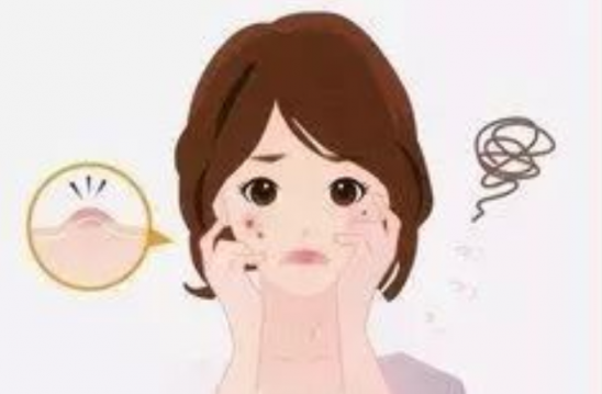 怎样去痘痘和痘印 防止痘痘反复