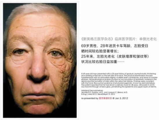 不涂防晒霜的危害 不涂防晒可不要后悔