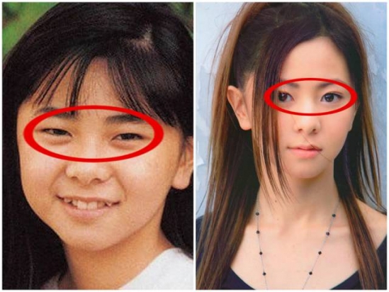 眼睑下至术是什么