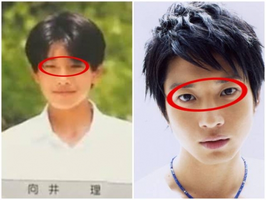 眼睑下至术是什么
