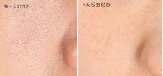 城野医生毛孔收敛水怎么样