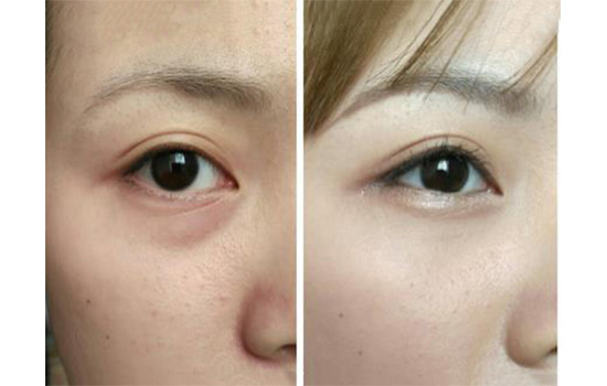 遮瑕膏怎么遮眼袋 遮瑕膏如何遮眼袋