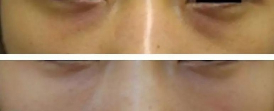 黑眼圈怎么遮瑕小窍门
