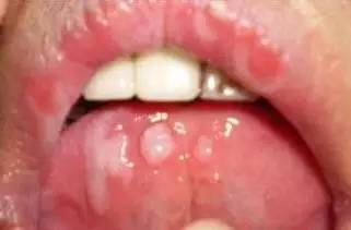缺少维生素b的危害