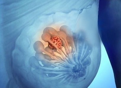 乳腺增生是怎么形成