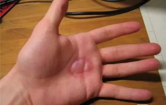 被开水烫伤怎么处理