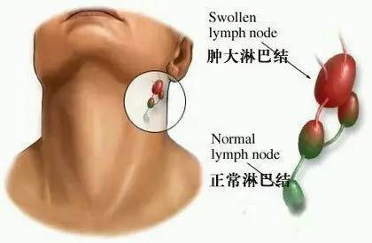 人体淋巴结分别在哪个部位 人体淋巴分布图