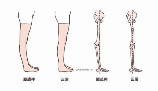 膝盖超伸怎么矫正 膝盖超伸最简单的纠正