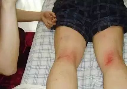 夏天湿气重不能吃什么水果