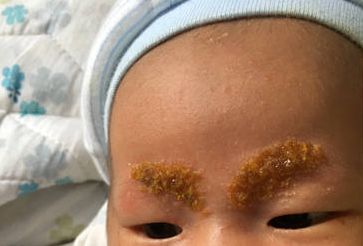 宝宝长湿疹怎么办