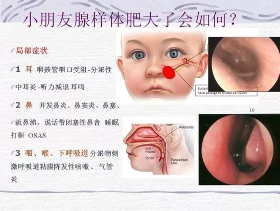 宝宝为什么会打呼噜