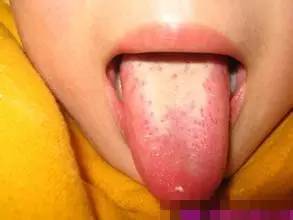 孩子快速止咳的方法