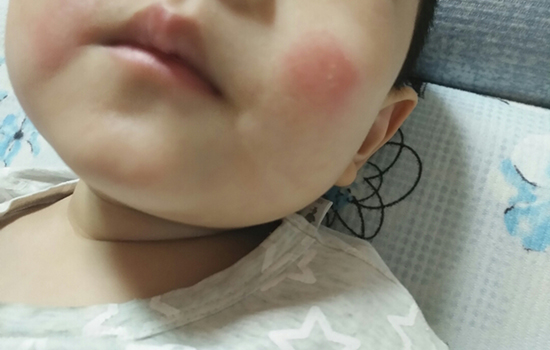 婴儿干性湿疹能自愈吗 婴儿干性湿疹能否自愈