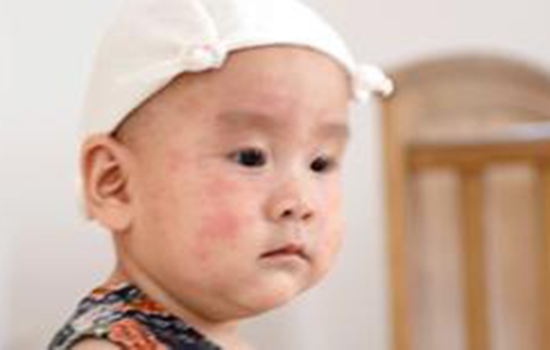 幼儿急疹症状 幼儿急疹有什么症状