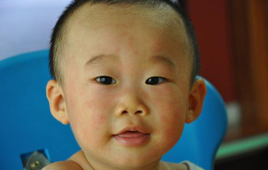 幼儿急疹是什么原因引起的 幼儿急疹是怎么引起的