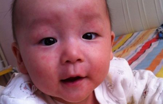 幼儿急疹出疹后护理 幼儿急疹出疹后怎么护理