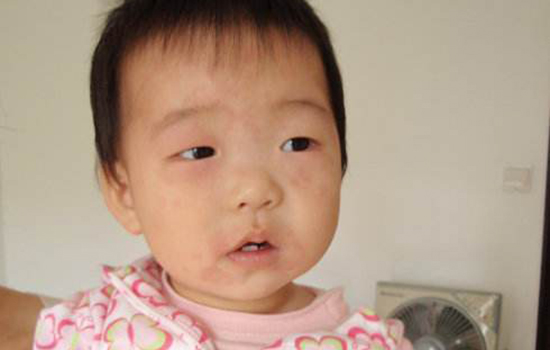 幼儿急疹出疹后护理 幼儿急疹出疹后怎么护理