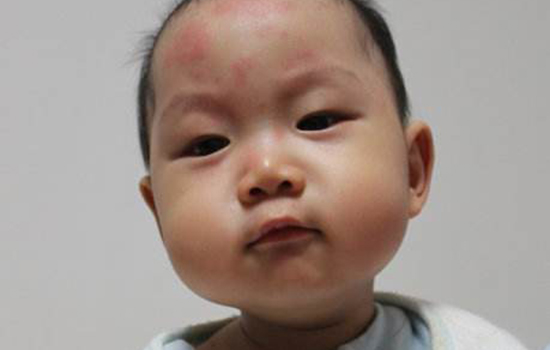 幼儿急疹能吹风吗 幼儿急疹能见风吗