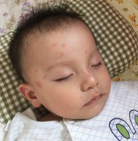 幼儿急疹能吹风吗 幼儿急疹能见风吗