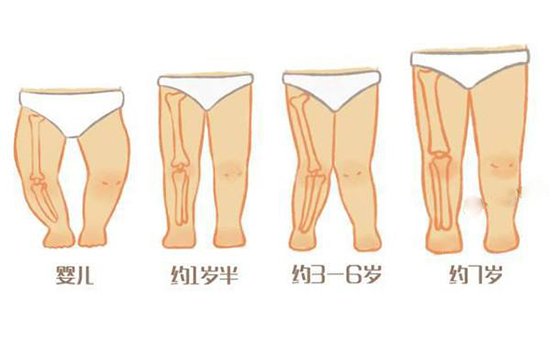 宝宝腿型不直怎么办 宝宝腿型不好看怎么办