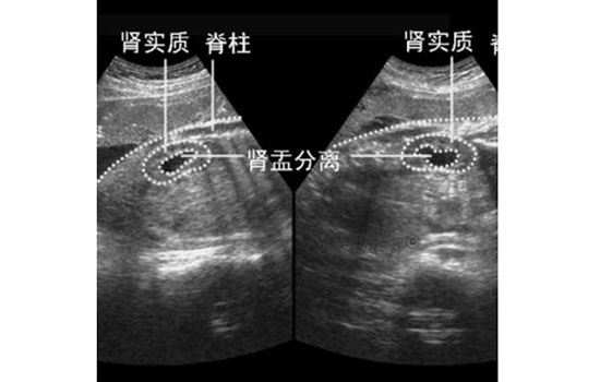 肾盂分离的胎儿能要吗 胎儿肾盂分离敢生吗