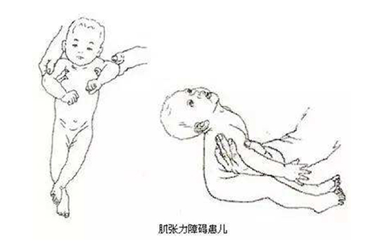 宝宝肌张力高怎么办 宝宝肌张力高怎么治疗