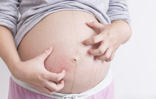 孕妇荨麻疹症状 孕妇荨麻疹有什么症状表现