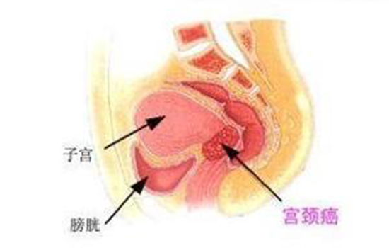 宫颈癌传染吗 宫颈癌会不会传染