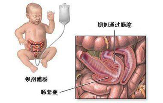 肠套叠手术是大手术吗 肠套叠手术治疗