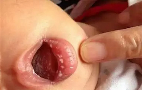 鹅口疮和马牙的区别 怎么区分马牙和鹅口疮