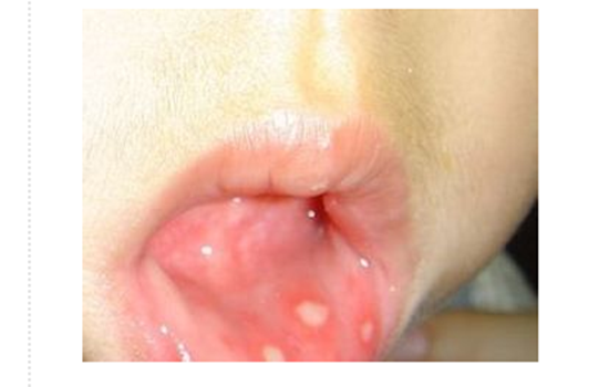 鹅口疮和口腔溃疡的区别 婴儿鹅口疮和口腔溃疡