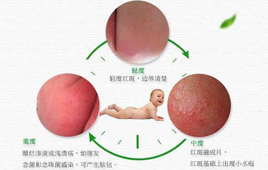 夏天婴儿红屁股怎么办 新生儿夏天屁屁红