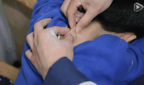 小儿推拿的21种手法