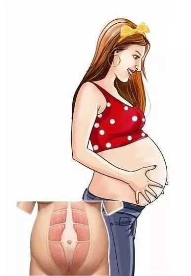 什么是产后腹直肌分离