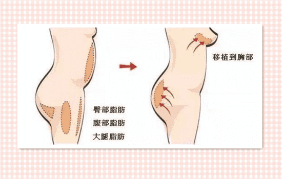 自体脂肪丰胸好不好 自体脂肪丰胸好不好