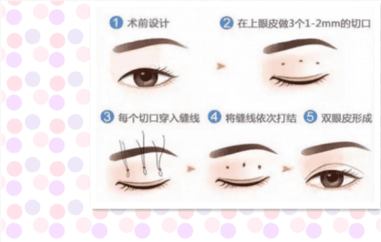 埋线双眼皮为什么会消失 埋线双眼皮为什么会开