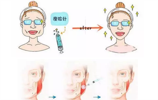 哺乳期可以打瘦脸针吗 哺乳期能不能打瘦脸针