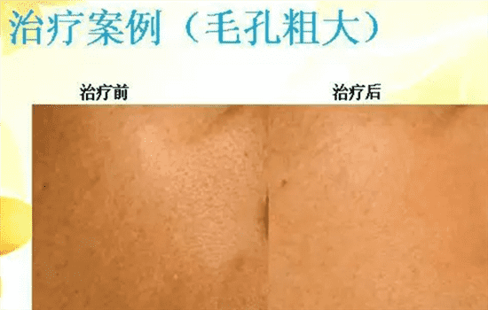 点阵激光能缩小毛孔吗 点阵激光对毛孔有用吗