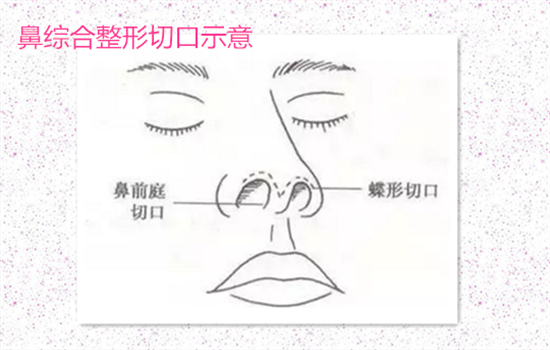 鼻综合是什么意思 什么是鼻综合整形
