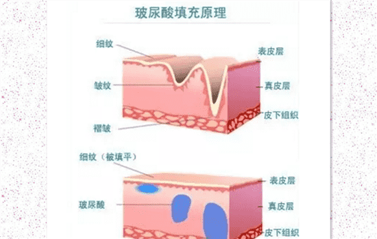 玻尿酸去除法令纹好吗 玻尿酸去除法令纹怎么样