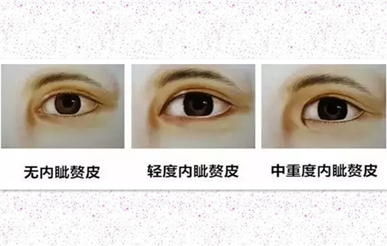 什么人不适合开眼角 哪些人不适合开眼角