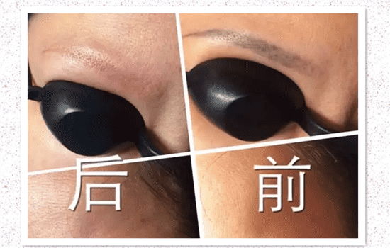 用激光洗眉会留疤痕吗 激光洗眉毛会不会留疤