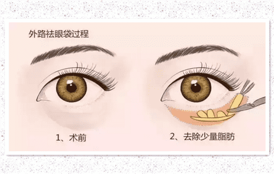 眼袋手术后多长时间恢复正常 去眼袋手术几天恢复期