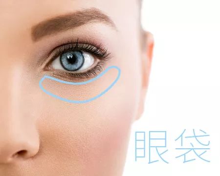 怎么样祛除眼袋