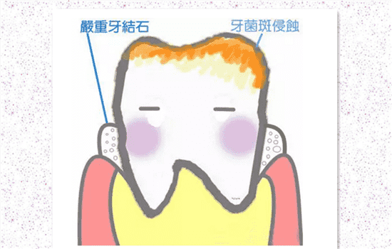洗牙会感染艾滋病吗 洁牙会感染艾滋病吗