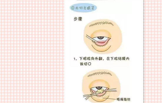 去眼袋有几种 去眼袋手术有几种方法