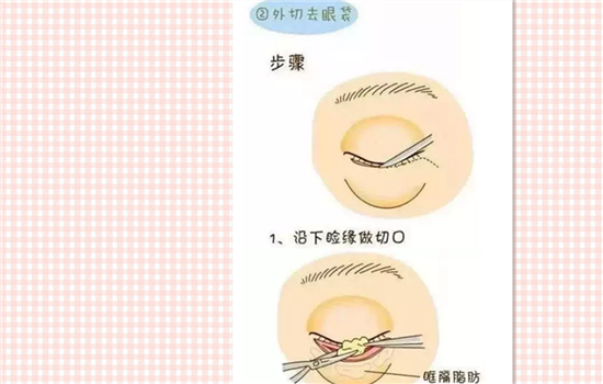 去眼袋有几种 去眼袋手术有几种方法
