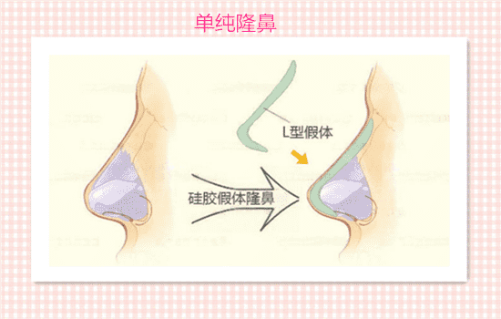 单纯隆鼻和综合隆鼻的区别 假体隆鼻和鼻综合区别