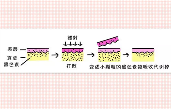 做白瓷娃娃后怎么护肤 做完白瓷娃娃怎样护理