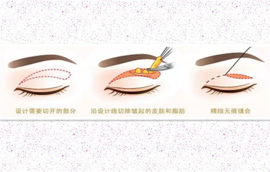 肿泡眼能埋线双眼皮吗 肿泡眼可以埋线吗